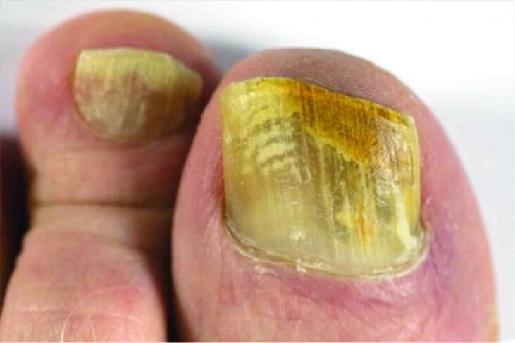 Feeling of nails on feet