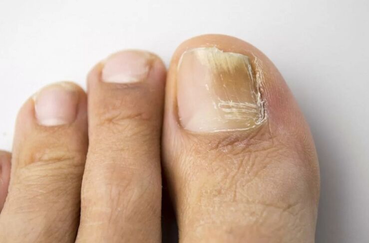 Mycosis of nails on your feet