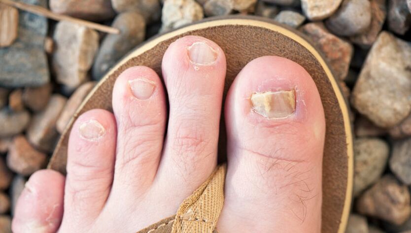 Onychomycosis of nails